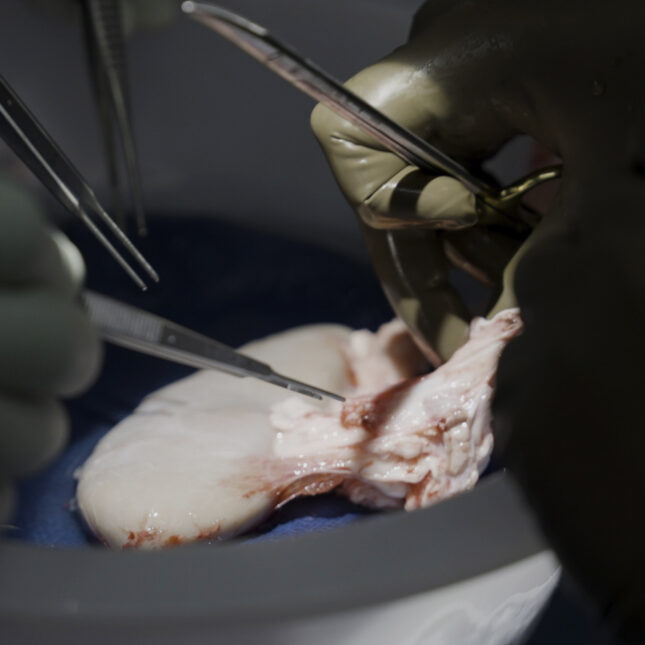 Recipients of gene-edited pig kidneys successfully receive human organs