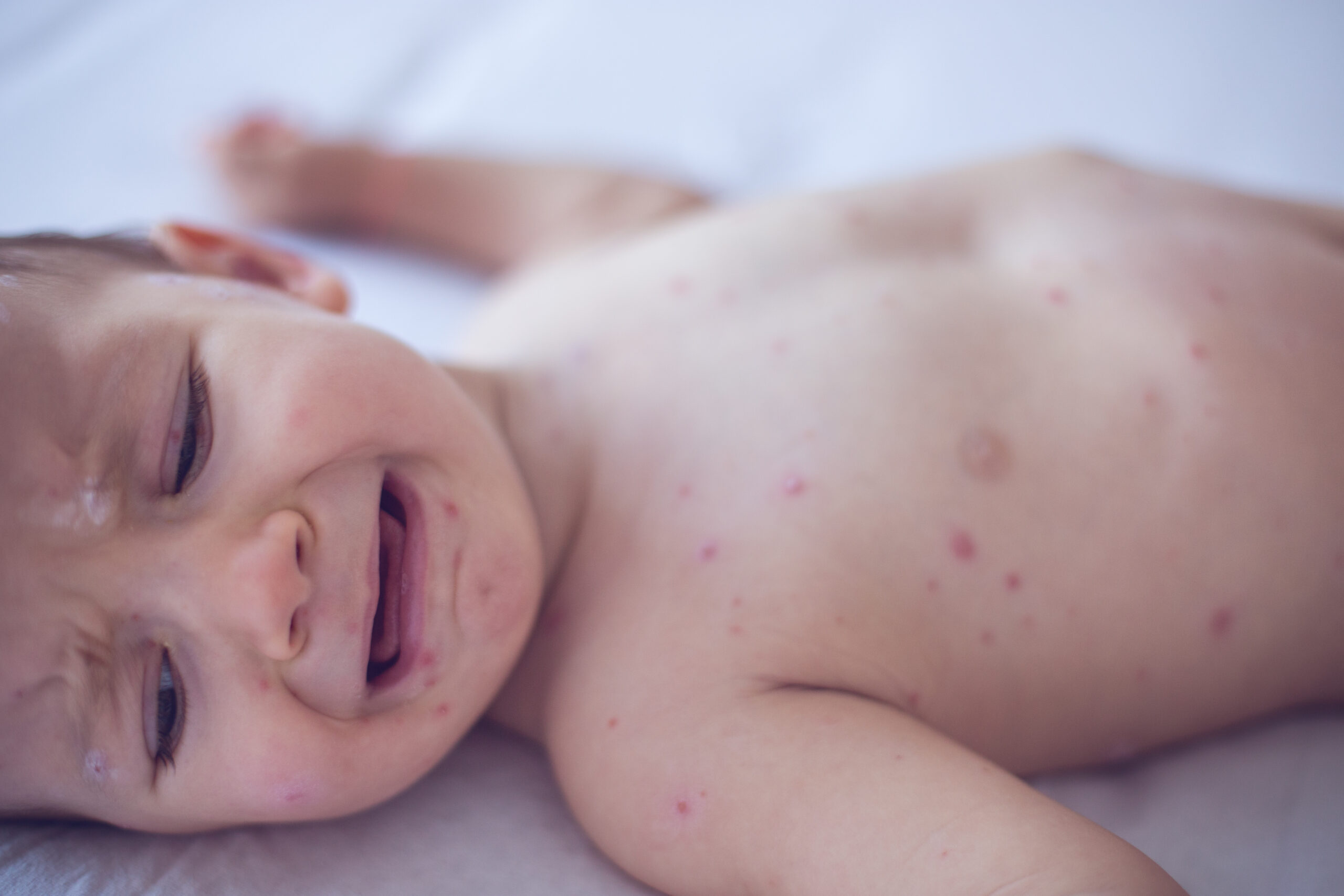Measles killed 6-week-old baby, coroner confirms after RFK Jr. disputed deaths