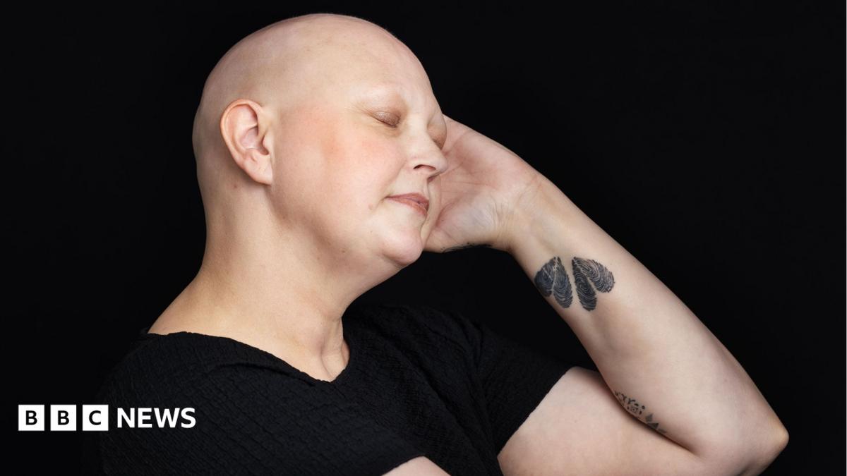 Cancer survivors living with chemo hair loss celebrate resilience
