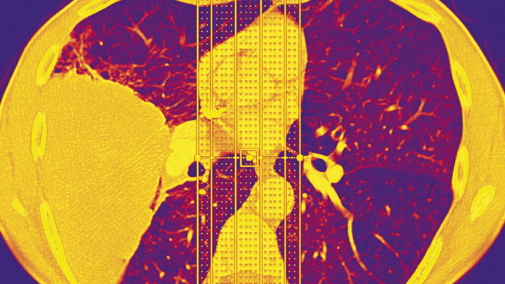 Why do ‘never smokers’ get lung cancer? In some cases, rare genetic variant may be a factor