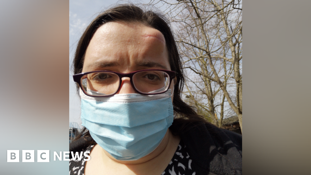 'Lump on head was cancer eating hole in my skull'