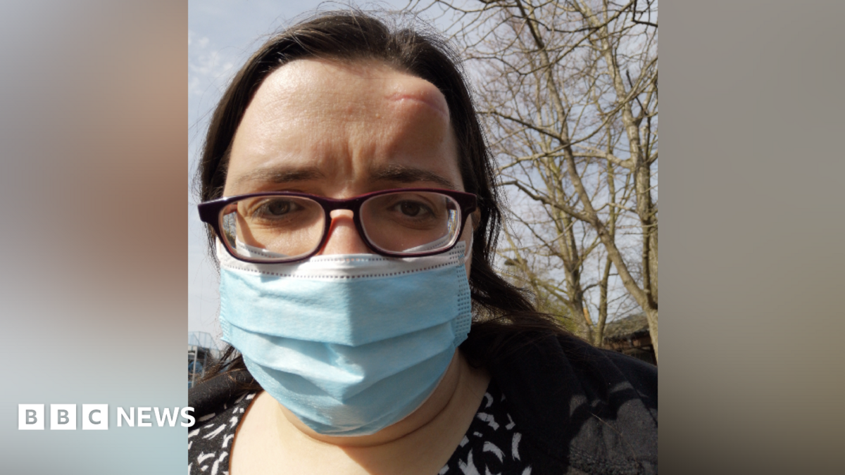 'Lump on head was cancer eating hole in my skull'