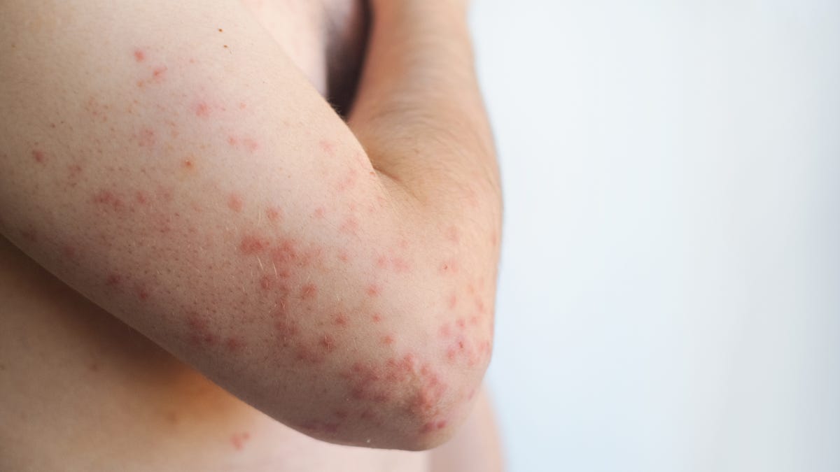 Why CDC counts only 1 measles death while Pennsylvania reports 4