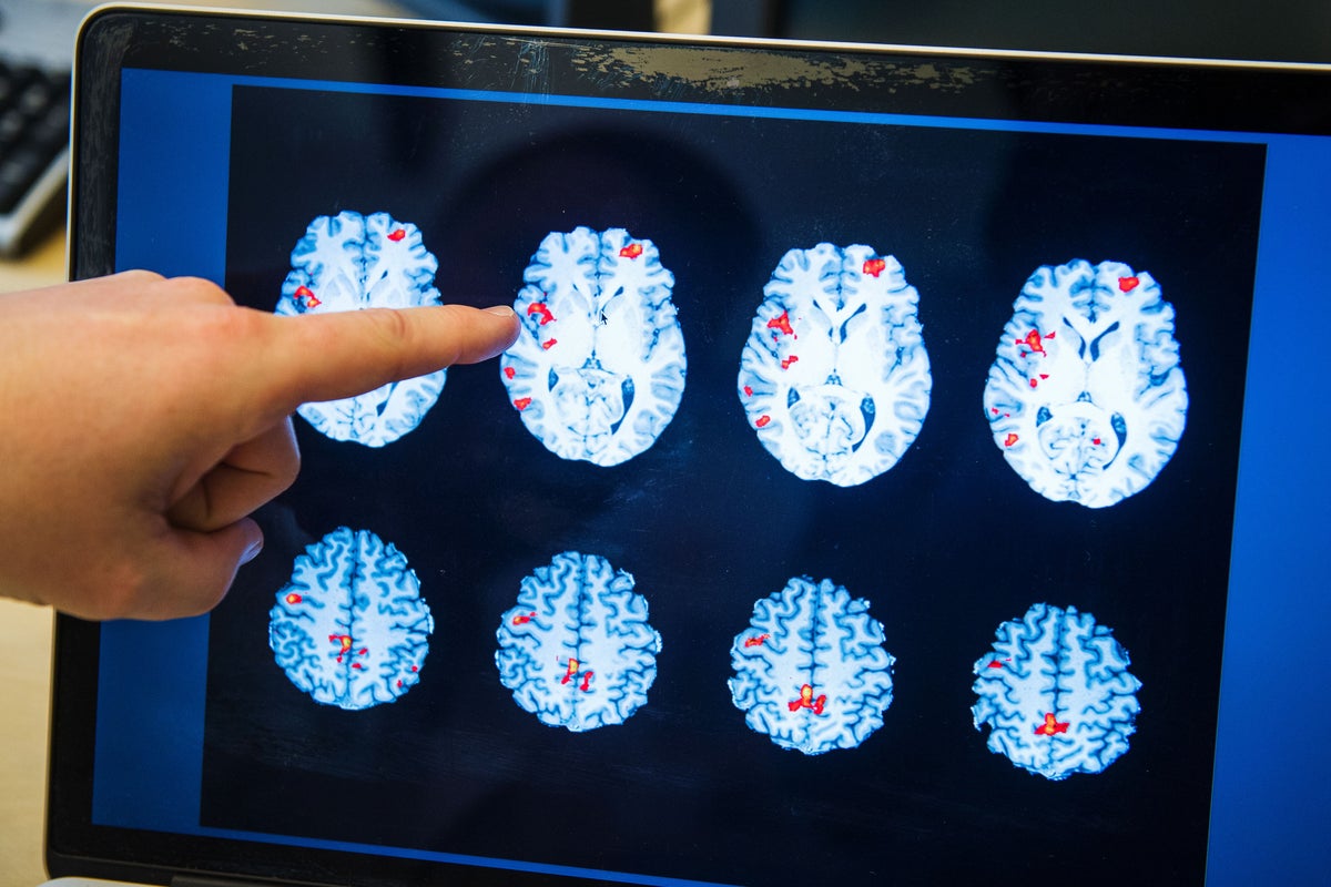 Hopes for thousands after breakthrough in brain tumour treatment