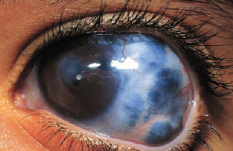 Glaucoma cases rise amid self-medication, delayed eye screening