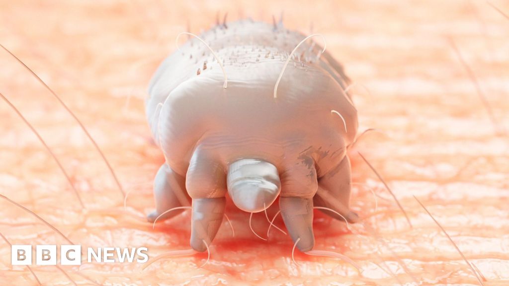 Scabies outbreak at Prince Philip hospital closes wards