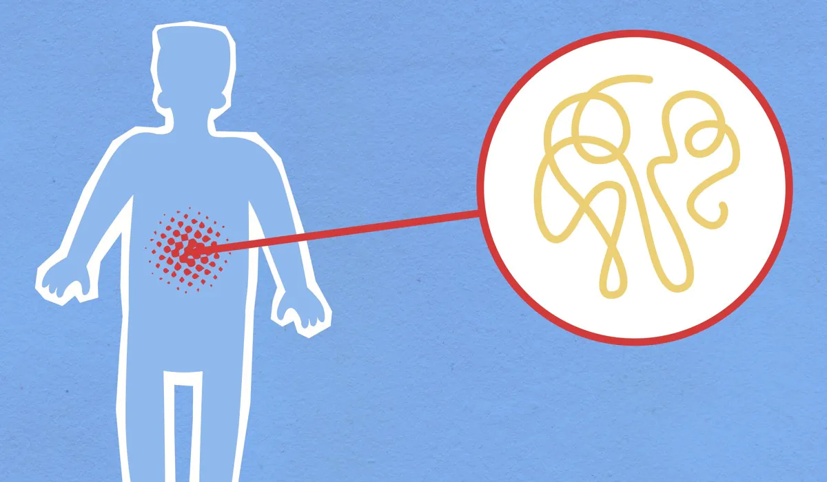 WHO Cancer Study Finds 12% of New Cases Linked to Infections, With Stomach Bacteria Leading the List