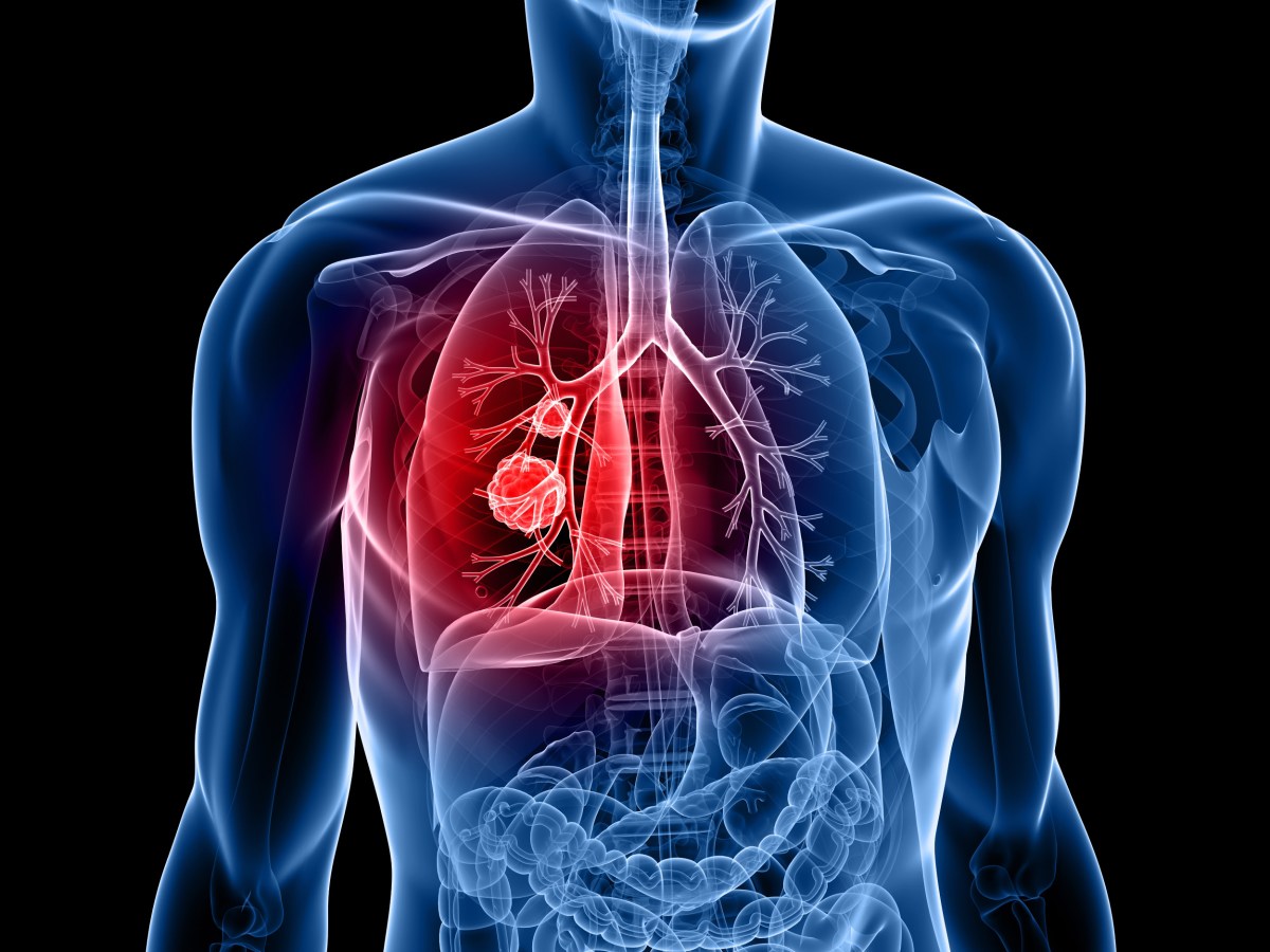 New Blood Test Can Find One of the Deadliest Cancers Returning—Before Scans