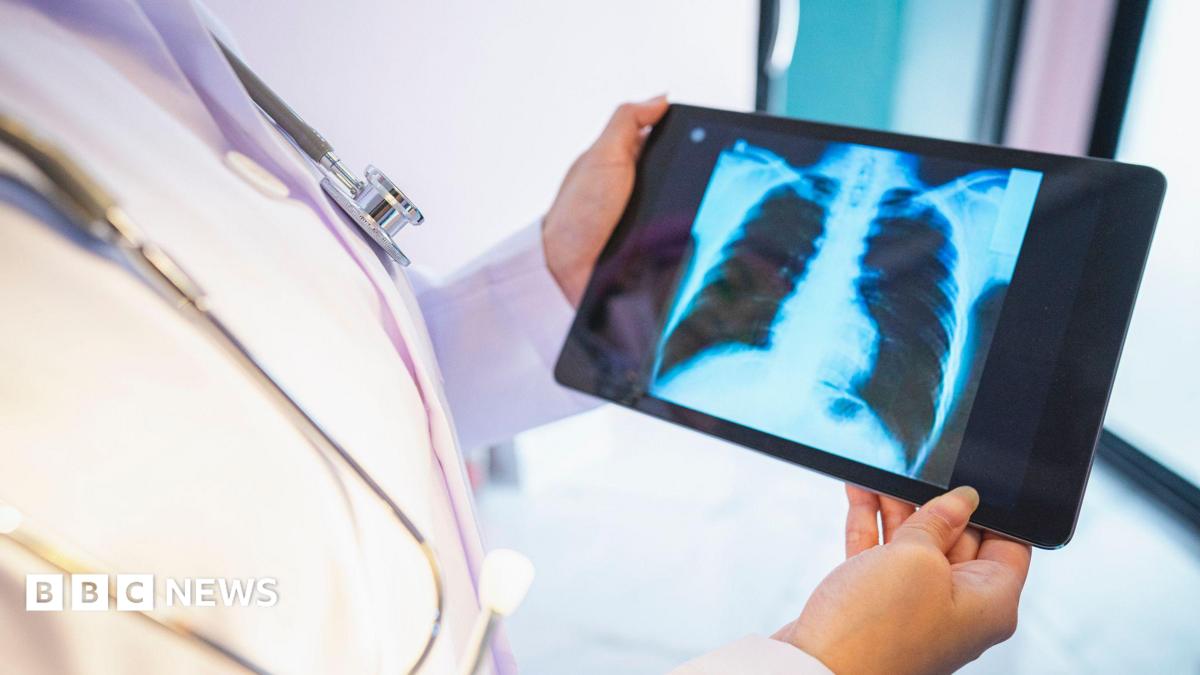 Lung cancer screening to begin for 90,000 people